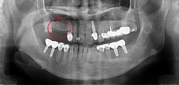 植牙case3 已缺牙一段時間重建治療 鼻竇增高術式 師院口腔醫療聯盟